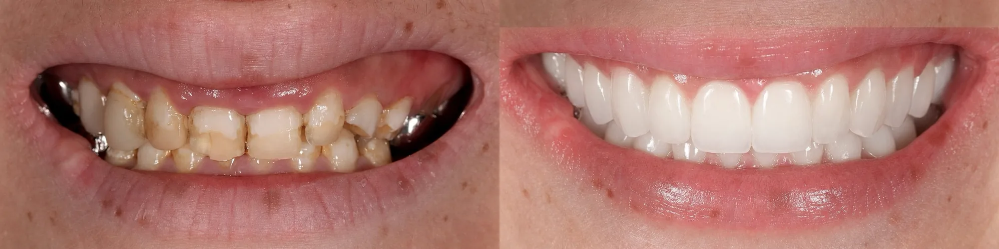 Carillas dentales en Gandia: Restauración de dientes desgastados recuperando forma y proporción.