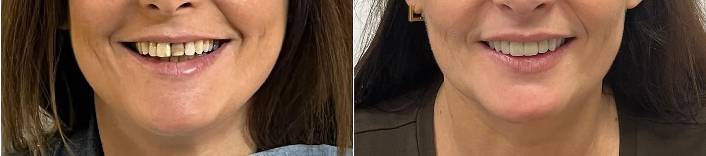 Carillas dentales en Gandia: De un color apagado y bordes irregulares a una sonrisa blanca y armónica.