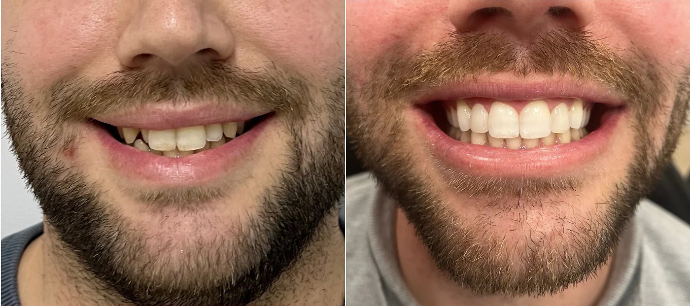 Carillas dentales en Gandia: Corrección de forma y color para una sonrisa uniforme y natural.