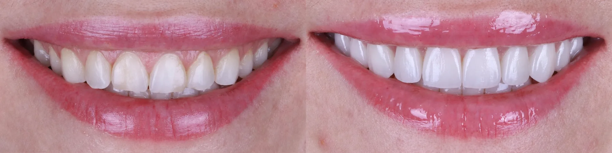 Microcarillas invisibles en Gandia: Mejora de la armonía de color y forma en el sector visible de la sonrisa.
